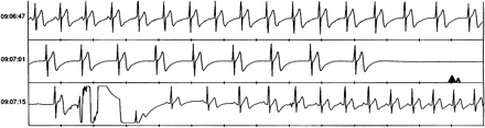 Event recorder tracing showing a 4.8 s asystole period in a 31 year old subject. Time is indicated on the right scale. After a few sinus beats, there is a progressive slowing of a junctional rhythm ending into asystole. Recovery of sinus rhythm is evident in the bottom panel.
