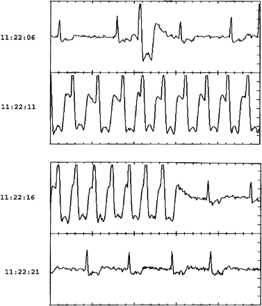 Event recorder tracing showing a bout of wide QRS tachycardia during a syncopal episode.