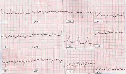 ECG on the admission shows sinus rhythm with a heart rate of 100 bpm, QT = 0.40–0.44 ms and QTC interval from 520–570 ms.