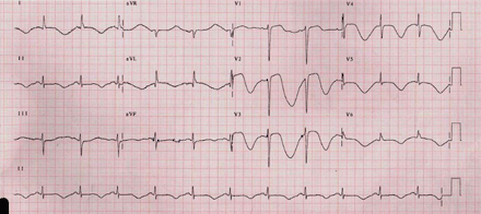 ECG recorded after complaints of dizziness and chest discomfort shows sinus rhythm, 72 bpm, QRS complex without any changes, resembling the QRS at the time of admission (Fig. 1). Significant QT and ST-T changes: extreme QT prolongation, QT = 720–760 ms and QTC interval from 789–830 ms, with concomitant giant, inverted T-waves, beat-to-beat T-wave changes – “macroscopic T wave alternans” – especially in right chest leads.