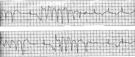 Example of monitoring ECG lead. Intermittent runs of non-sustained torsades de pointes, ventricular tachycardia and sinus rhythm with an extremely long QT interval and beat-to-beat T changes.