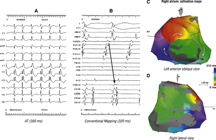 Mapping was performed using conventional and CARTO electro-anatomical mapping system in a 44 year-old woman who had undergone staged repair of Ebstein's anomaly. The ECG in panel A suggests AT. However, conventional mapping (in panel B), showed a clockwise reentry along the TA. Panel C, a solid isochronal activation map of the right atrium, confirms the clockwise typical AFL. Panel D shows an extensive scar (grey coloured) extending along the superior–anterior–inferior right atrium, forming the posterior boundary of the typical AFL circuit.