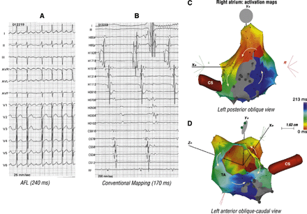 This 44 year-old man underwent patch closure of the septal defect resulting after excision of a left atrial myxoma. Panel A suggests AFL with positive flutter waves in lead II and negative in lead III. Panel B shows counterclockwise activation along the TA. The bipole CS 9–10 is not activated in tandem with the Halo catheter and double potentials, as a result of previous ablation, were recorded on the cavotricuspid isthmus (bipole RF). These findings suggest a bystander counterclockwise activation along the TA. Panel C confirms reentry around the septal scar. Activation along the TA, seen in panel D, via two wave fronts that collide in the posterior isthmus at the site of previously obtained bi-directional block is bystander.