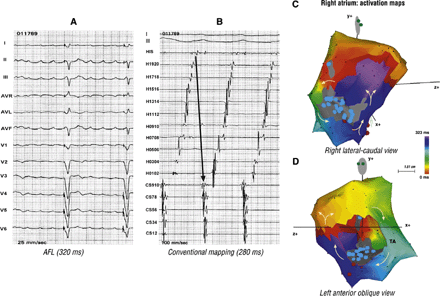 Atrial septal defect was closed directly in this 44 year-old woman. She had previously undergone His ablation followed by pacemaker implantation because of recurrent AAs. Panel A suggests AFL with positive flutter waves in the inferior leads. Conventional mapping, in panel B, might suggest clockwise typical AFL. Panel C and D, seen together, confirm double-loop reentry as the mechanism of this AA. The first loop is around the right lateral atriotomy scar and the second is along the TA in a clockwise direction. An unconventional isthmus, between the atriotomy scar and the TA is shared by both the loops.