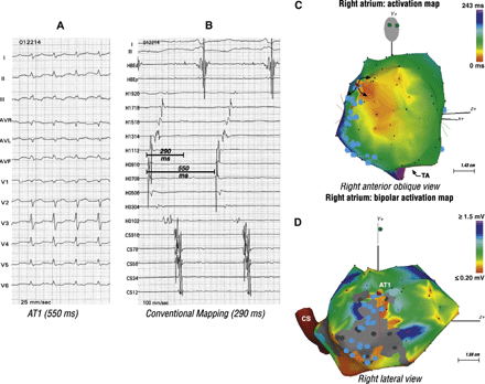 Mapping and ablation of two focal ATs in a 55 year-old woman post atrial septal defect closure. Panel A shows the first AT (AT1). Panel B showed bi-directional activation along the crista terminalis (Halo catheter) and a short biatrial activation time suggestive of a focal mechanism. Panel C shows origin of the focal AT1 in the high anterior right atrium (orange). Panel D, a bipolar voltage map, shows relation of AT1 to the atriotomy scar.