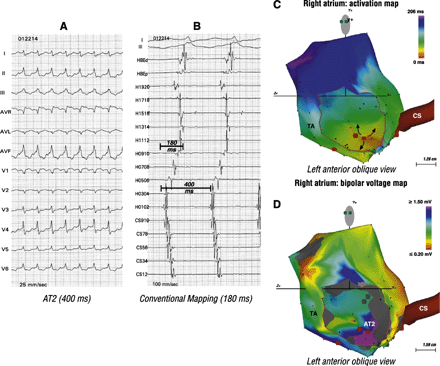 A second AT (AT2) found in the patient described in Fig. 4. Panel A shows AT2. Once again, panel B, shows bi-directional activation along the crista terminalis and a short biatrial activation time. These findings suggest a focal mechanism. Panel C shows origin of the focal AT2 from the low posterior right atrium. Panel D shows relation of AT2 to the septal scar.