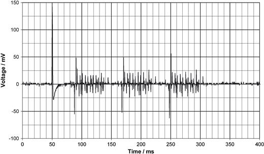 Scan triggered by an AAT mode pacemaker which prolongs the possible scan period by the AV-interval to up to 450 ms (here not used).