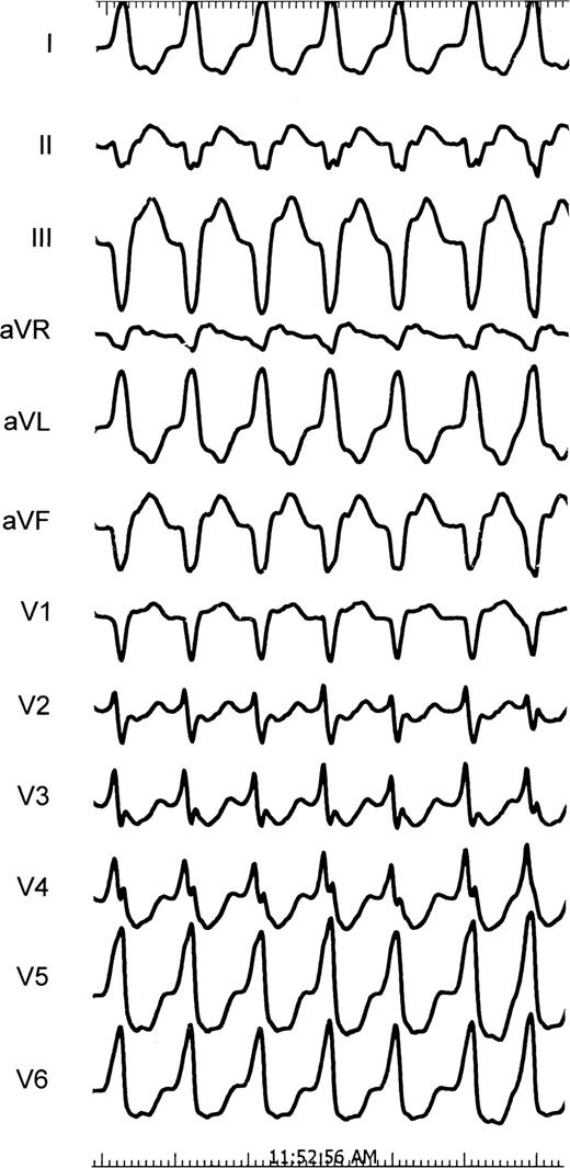 Twelve lead ECG recorded (speed 25 mm/s) during electrophysiological study showing ventricular tachycardia of left bundle block morphology with left axis deviation.