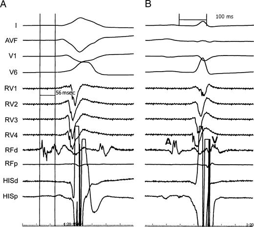 (A) Earliest endocardial activation recorded by the ablation catheter at the successful ablation site in the subtricuspid septum of the right ventricle. (B) Atrial (A) and ventricular (V) electrograms recorded by the ablation catheter at the right ventricular septum after successful radiofrequency ablation of the ventricular tachycardia focus.