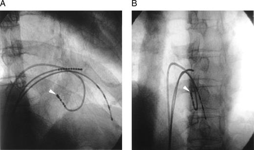 Fluoroscopic images obtained in the right anterior oblique (A) and left anterior oblique (B) projections (30°) showing the successful ablation site. The distal electrodes of the ablation catheter (arrow) are positioned at the subtricuspid septum of the right ventricle.