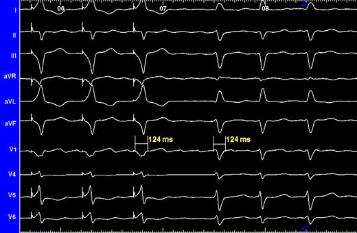Surface ECG. Three leftmost QRS complexes resulted from His bundle pacing, whereas the remaining ones are intrinsically conducted. ECG concordance provides evidence of successful His bundle pacing.