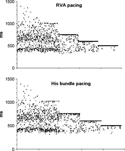 Successive R–R intervals during RVA and His bundle pacing at 60, 80, 100, and 120 bpm. The regularization of ventricular rhythm becomes evident at pacing rates slightly above the mean spontaneous rate. Further increase of pacing rate results in blocking all antegrade impulses.