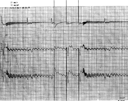 Medtronic Minix ST 8330 patient ECG record. Starting with a pacing burst at approximately 2000 ppm for about 3 s with decreasing amplitude and rate. Patient's own rhythm, atrial flutter, with ventricular escape rhythm at 30 bpm. In the middle, three spikes are seen at 60 ppm in VOO mode, the first in ventricular refractory. Later, re-initiation of the phenomenon is shown.