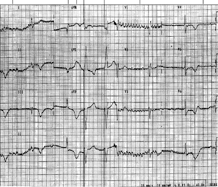 Triumph VR 1124 CPI pacemaker patient ECG recording. Spike burst at approximately 2000 ppm with decreasing amplitude and frequency. The underlying rhythm is complete AV block with escape beats at 40 bpm. Captured beats at 60 ppm are observed in the middle of the strip. Re-initiation of the phenomenon is shown.