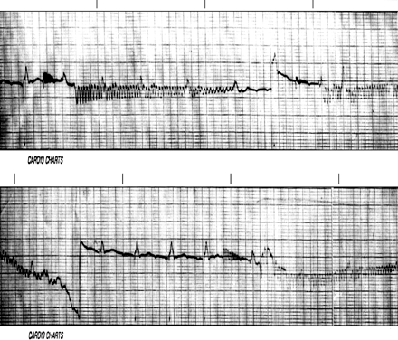 Medtronic Minix ST 8330 pacemaker patient runaway phenomenon. Continuous strip: at the top, some captured beats may be observed alternating with rapid, non-captured beats of irregular stimuli at 2000 ppm. During this episode the patient's spontaneous rhythm is shown. The sequence is randomly repeated.