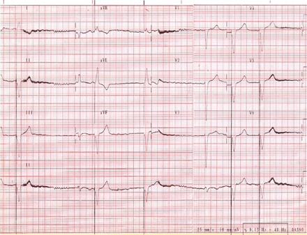 ECG showing pacemaker rhythm alternating with the patient's own rhythm with different intervals. After the first beat, a typical runaway phenomenon is observed with a 2100 ms pause and a subsidiary escape rhythm. The following paced beat is delivered without correct sensing. The last two paced beats have an interval of 1000 ms.