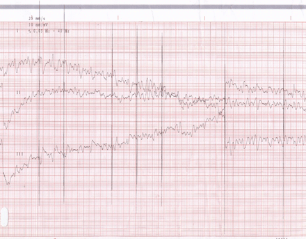 ECG shows a storm of ventricular fibrillation. Spikes with different intervals. Previously the patient presented ventricular tachycardia (torsade de pointes) and had to be defibrillated.