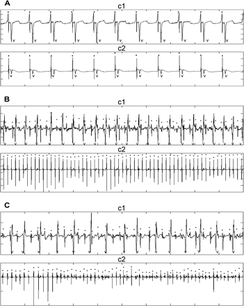 Epicardial atrial signals during sinus rhythm panel (A) and AF before panel (B) and after amiodarone + metoprolol in patient 10 panel (C). Traces labeled c1 are recorded from the right atrial inferior free wall, and traces labeled c2 are recorded from the left atrium near the left inferior pulmonary vein. Ten second data segments are shown. The left fibrillatory activity is regular before (B-c2) and after (C-c2) the drug.