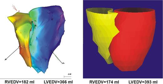 Exemplary three-dimensional models of the LV and RV with CMR (left) and CARTO (right) in a patient with dilated cardiomyopathy.