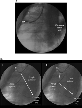 Fluoroscopic images of defibrillation leads. (A) Defibrillation leads for experiments 1 and 2. S, stimulator; RA, right atrium; (−), cathode; (+), anode. (B) Defibrillation leads for experiment 3. The standard single pathway is shown in panel 1, whereas the defibrillation electrodes used for dual pathway shocks are shown in panel 2. RA, right atrium; (−), cathode; (+), anode.