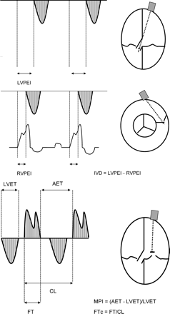 Assessment of LVPEI, RVPEI, IVD, FTc, and MPI from the ECG, the transaortic, the transpulmonary, and transmitral pulsed wave Doppler signals in the apical four-chamber view and the parasternal short axis view, respectively. CL, cycle length; ECG, electrocardiogram; AET, time between two diastolic filling periods.