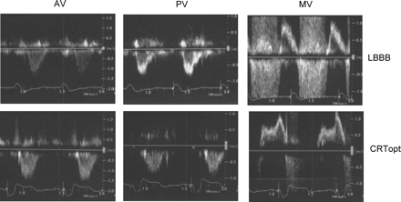 Pulsed wave Doppler tracings of transaortic (AV), transpulmonary (PV), and transmitral (MV) flow from one patient during intrinsic LBBB and during optimized CRT. Optimal mode in this case: biventricular pacing with 90 ms sensed AV delay. Reduction in LVPEI (195–153 ms), IVD (73 ms to −11 ms), and MPI (0.53–0.48), and prolongation of FTc (0.48–0.51), and RVPEI (122–164 ms). Note also the reduced mitral regurgitation signal with CRTopt. CRTopt, cardiac resynchronization therapy with optimal settings.