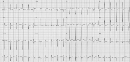 The 12-lead ECG during clinical tachycardia. The atrioventricular relationship is 1:1 with P waves seen immediately following the QRS complex.