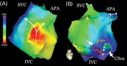 Electroanatomic recreation of the right atrium seen from the left anterior oblique view recorded during (A) tachycardia and (B) sinus rhythm. Activation is encoded by colours and depicted in the bar on the left-hand side of the image; red is earliest and purple latest activation. The superior caval vein (SVC), IVC, CSos, and atriopulmonary anastamosis (APA) have been annotated. The position of the His bundle electrogram (His, yellow dots) has been marked anterior and superior to the CSos. During tachycardia (A) earliest activation can be seen immediately superior to the His bundle in the presumed position of the fast pathway, and progresses initially along superiorly (curved white arrows) and then inferiorly along the atrial septum, following which wave fronts progress both medially and laterally around the chamber ultimately colliding on the posterior wall (not seen). Radiofrequency energy (red dots) was applied during sinus rhythm (B) initially adjacent to the CSos and moved superiorly until an accelerated junctional response was seen. The successful lesion is marked with a white arrow.