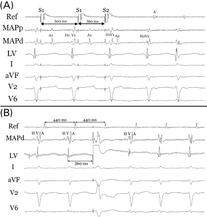Surface electrograms from leads I, aVF, V2, and V6 with contact bipolar electrograms recorded from the right atrium (Ref), right atrial septum (map), and left ventricle (LV). (A) demonstrates programmed atrial stimulation (S1 500/S2 360) where the extra stimulus (S2) prolongs A2H2 leading to retrograde atrial activation (A') via the fast pathway (echo beat) and initiation of tachycardia. (B) During AVNRT (CL 440 ms) with the mapping catheter positioned approximating the His bundle a His (H) deflection can be seen leading ventricle (V) and atrium (A). Atrial activity was earliest in this area. A HSVPB at 360 ms captures the ventricle but fails to pre-excite the atrium supporting a diagnosis of AVNRT.