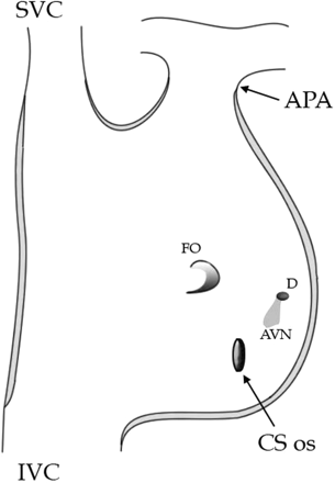 A drawing of the right atrium following the atriopulmonary Fontan procedure as performed in the patient described in this case viewed from the anterior approach. The position of the compact AVN is shown in the floor of the right atrium, anterior, and superior to the position of the CSos. The dimple (D) marks the position of the central fibrous body, the site of penetration of the His bundle. FO=fossa ovalis.