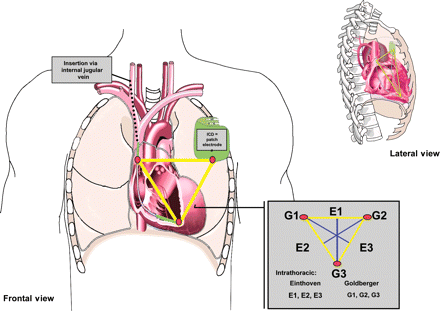 Assessment of the six IT-ECG leads (according to Einthoven, E1–E3 and Goldberger, G1–G3) by use of three electrodes placed in the RVA and SVA (inserted via the internal jugular vein) and the generator site (cutaneous patch). The frontal and lateral views are given.