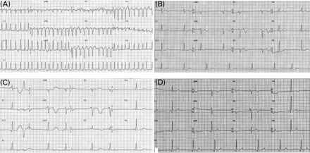 (A) Admission ECG revealing AF with a rapid ventricular rate of 227 bpm (B) Following cardioversion, an ECG revealed sinus bradycardia (44 bpm) with a QTc interval at the upper limit of normal for a woman (449 ms), accompanied by non-conducted premature atrial complexes. (C) After receiving oral amiodarone (200 mg/day for 4 days), an ECG showed a markedly prolonged QTc interval of 533 ms with T-wave alternans. (D) The QTc interval normalized to 428 ms after ceasing the oral amiodarone.