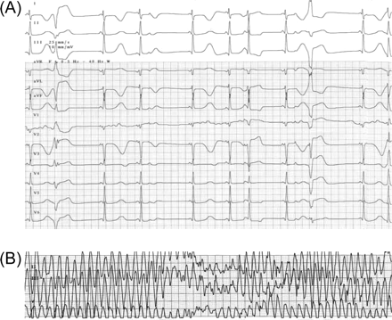 On the fourth day of amiodarone treatment, the ECG demonstrated QTc prolongation and frequent premature ventricular complexes with a short coupling interval (A), followed by the occurrence of TdP (B).