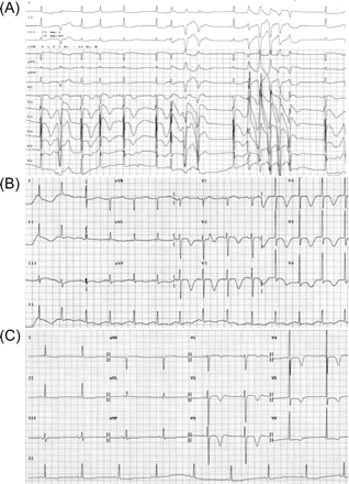 (A) Initial ECG revealed non-sustained polymorphic ventricular tachycardia with R on T phenomenon. (B) After administration of isoprenaline, the ECG showed a markedly prolonged QTc interval (528 ms) with broad T-wave inversion and without recurrence of TdP. (C). Note that the QTc (446 ms) was within the normal limit on the seventh day after discontinuation of amiodarone.
