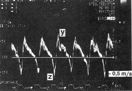Ventricular pacing with 1:1 retrograde conduction. In this transoesophageal pulsed-Doppler echocardiographic recording, positive values depict antegrade flow in a pulmonary vein, whereas negative values depict retrograde flow. After each ventricular stimulus (see ECG at the bottom of the tracing), a retrograde P-wave appears, resulting in regurgitation into the pulmonary vein (z-wave). With permission from Stierle et al.37
