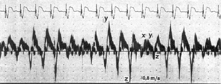 Ventricular pacing without retrograde conduction. Transoesophageal pulsed-Doppler echocardiographic recording as in Fig. 1. With VVI pacing rate (75 bpm) different from the sinus rate, P-waves appear shortly after the ventricular stimulus in three out of five cycles, resulting in regurgitation into the pulmonary vein (z-wave as in Fig. 1). With permission from Stierle et al.37