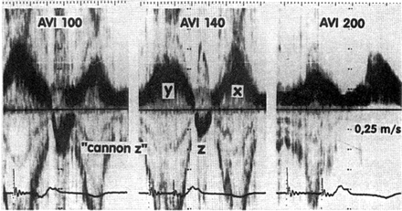 Dual-chamber pacing causing retrograde flow in the pulmonary vein. Transoesophageal pulsed-Doppler echocardiographic recording as in Figs. 1 and 2. With an AV delay of 100 ms (AVI 100, left panel), a large z-wave representing retrograde flow in the pulmonary vein appears. This z-wave is diminished but not abolished by reprogramming the AV delay to 140 ms (AVI 140, middle panel). Only after prolonging the paced AV delay to 200 ms (AVI 200, right panel), there is no longer retrograde flow in the pulmonary veins. With permission from Stierle et al.37