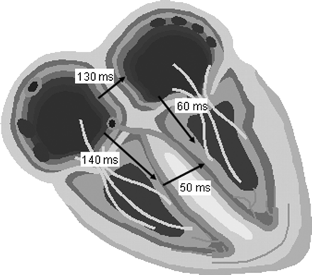 Example of the left-sided AV interval in IACD. In this case, an IACD of 130 ms, an interventricular conduction delay of 50 ms (mean value in Chirife et al.41), and a programmed AV delay of 140 ms would lead to a left-sided AV interval of only 60 ms.