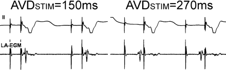 Left-atrial activation in relation to ventricular pacing in the DDDR/DDIR mode. After atrial pacing, left-atrial activity as measured with a transoesophageal left-atrial electrogram (LA-EGM) is delayed. Thus, in this case, ventricular stimulation occurs before left-atrial activity if the AV delay is programmed to 150 ms. Only after prolongation of the AV delay to 270 ms, left-atrial activation occurs just before the ventricular pacing spike. With permission from Ismer et al.38