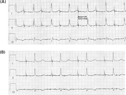 Example of a prolongation of the intrinsic AV conduction due to inappropriately fast atrial pacing. In this patient, an automatic sensor adjustment algorithm has increased the pacing rate to approximately 90 bpm at rest. This prolonged spontaneous AV conduction to approximately 300 ms causing ventricular fusion beats even with an AV delay programmed to 300 ms (A). After reprogramming the sensor, dual-chamber pacing at rest occurs at the lower rate limit of 70 bpm (B). Now, the spontaneous AV delay shortens again to 220 ms. Leads I–III, paper speed 50 mm/s.
