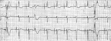 Ventricular pacing in the T-wave after a ventricular premature beat. If a ventricular premature beat coincides with the atrial stimulus, it may be sensed by the ventricular lead causing safety window pacing (first complex in the tracing) or it may be completely blanked out and the ventricular pace appears at the programmed AV delay (second complex from the right). The longer the AV delay is programmed, the more like the ventricular pace may capture in the ventricular vulnerable phase.
