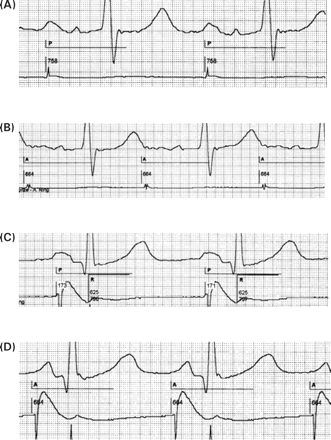 Intrinsic vs. paced P-wave duration and morphology: impact of atrial pacing site. In a patient with IACD (A, intrinsic P-wave duration 210 ms), P-wave duration is prolonged to 240 ms and P-wave morphology is further distorted if atrial pacing is performed from the lateral high right atrium (B). Any AV delay <240 ms will pace the ventricle before the end of atrial depolarization. In a patient with an intrinsic P-wave of 130 ms (C), atrial septal pacing near Bachmann's bundle synchronizes right- and left-atrial activation leading to a rather narrow peak of the P-wave and in this case to a small decrease of P-wave duration to 100 ms (D). Paper speed 100 mm/s, lead II and atrial electrograms. A: atrial pace; P: atrial-sensed event; R: ventricular sensed event; numbers: atrial cycle length, AV delay, VA interval and ventricular cycle length in ms.