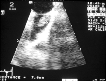 Thrombus in the left atrial appendage.