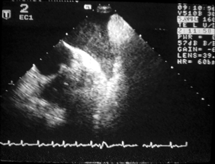 Spontaneous echo contrast in the left atrial appendage.