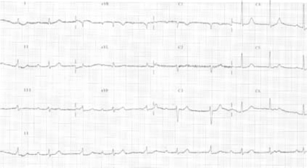 ECG of complete AV block on admission to the hospital.