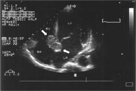 Transthoracic echocardiogram showing 4×2 cm smooth surfaced, homogeneous echogenic mass (shown with arrows) involving the lower one-third of the interatrial septum, membranous interventricular septum, and protruding into the right ventricle.