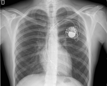 Postero-anterior view of chest X-ray of patient, 15 years old (height 192 cm) implanted at the age of 10 years (height 146 cm) with a VVIR PM for post-operative AV block. After 5 years, the ventricular lead is stretched and the tip seems displaced beneath the tricuspid valve; abnormal threshold increase with loss of capture was documented. The system was upgraded with a VDD PM and lead using the same left subclavian vein. The old lead was not removed.