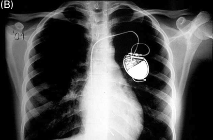 Chest X-ray of a girl at the age of 9 years in 1992 (A) and in 2001 (B). The ventricular lead, implanted in 1990, was fixed to the subcutaneous tissue with a slowly absorbable ligature. After patient's growth, the lead maintains an adequate position with normal function.