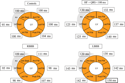 Time to onset of systolic velocity (from the onset of QRS complex to the onset of myocardial systolic velocity on TDI) in the ‘bull-eye’ projection for the six LV walls assessed in controls, HF patients with normal QRS (duration < 100 ms), RBBB and LBBB patients. Ant, anterior; FW, free wall; Inf, inferior; Lat, lateral; Post, posterior; Sept, septum.