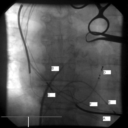 Transeptal puncture using the Daig SL1 System (AP view); A, Active fixation dual shock coil DF and pacing lead; B, Daig SL1 puncture kit; C, LV bipolar lead still in RA; D, CS lead (temporary); E, RVA temporary Electrode (for orientation); F, old RVA lead. RAO, right anterior oblique, DF, defibrillation, LV, left ventricle, CS, coronary sinus, RVA, right ventricular apex.